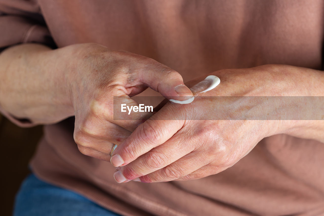 Elder woman applying cream or ointment to her hands with atopic dermatitis, eczema, allergy reaction