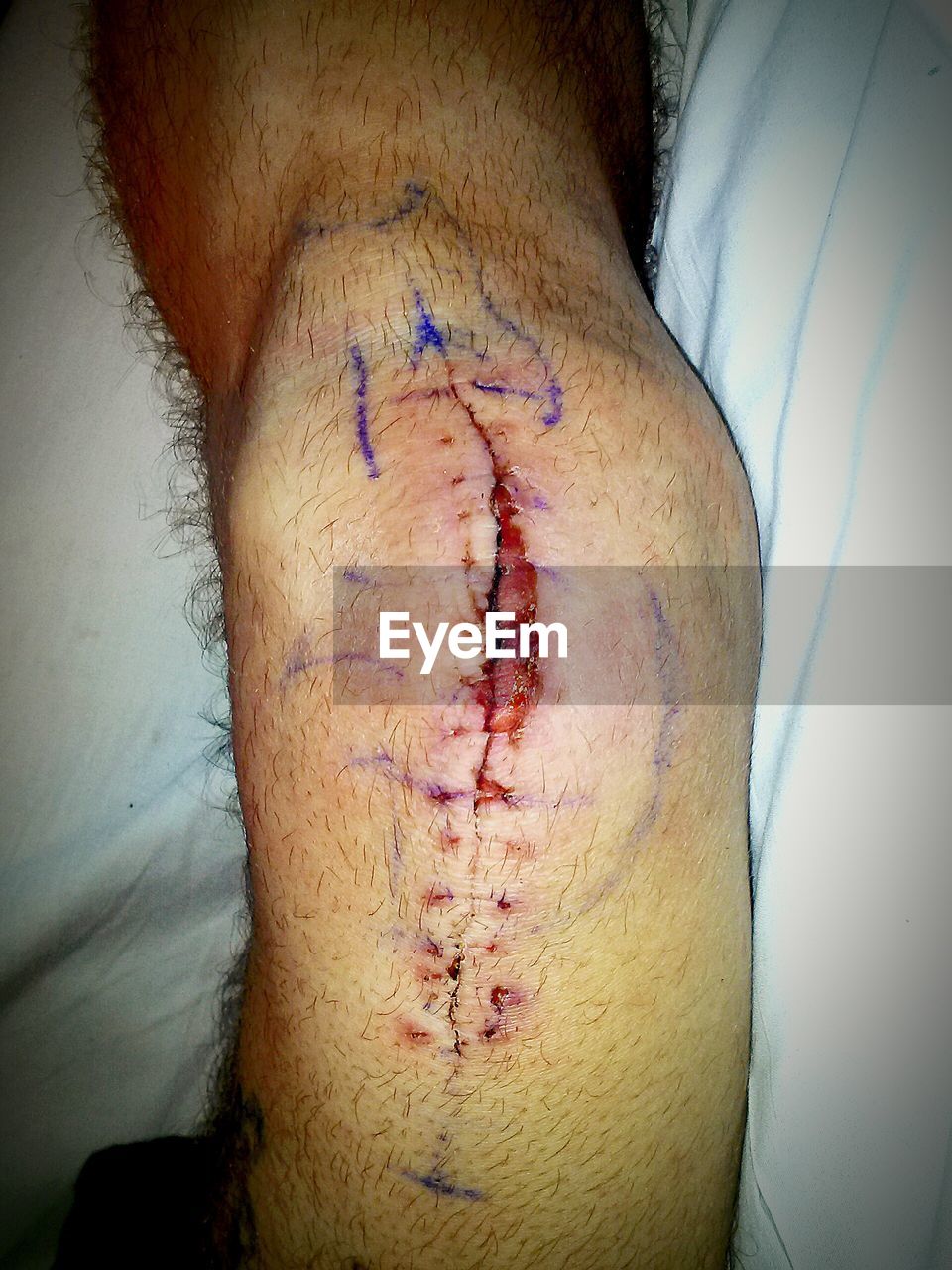 Knee replacement incision