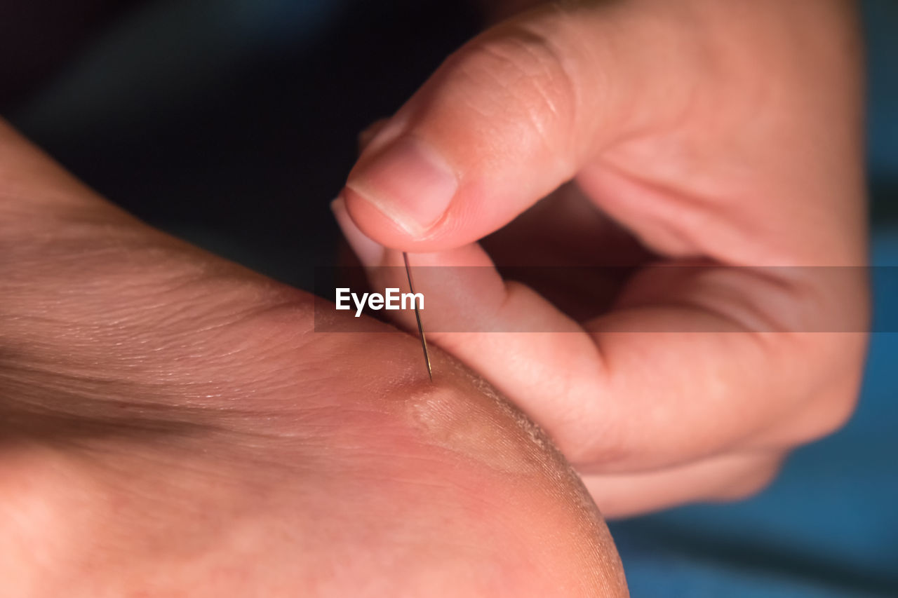 Women's fingers pierce a callus on the heel with a needle. close-up