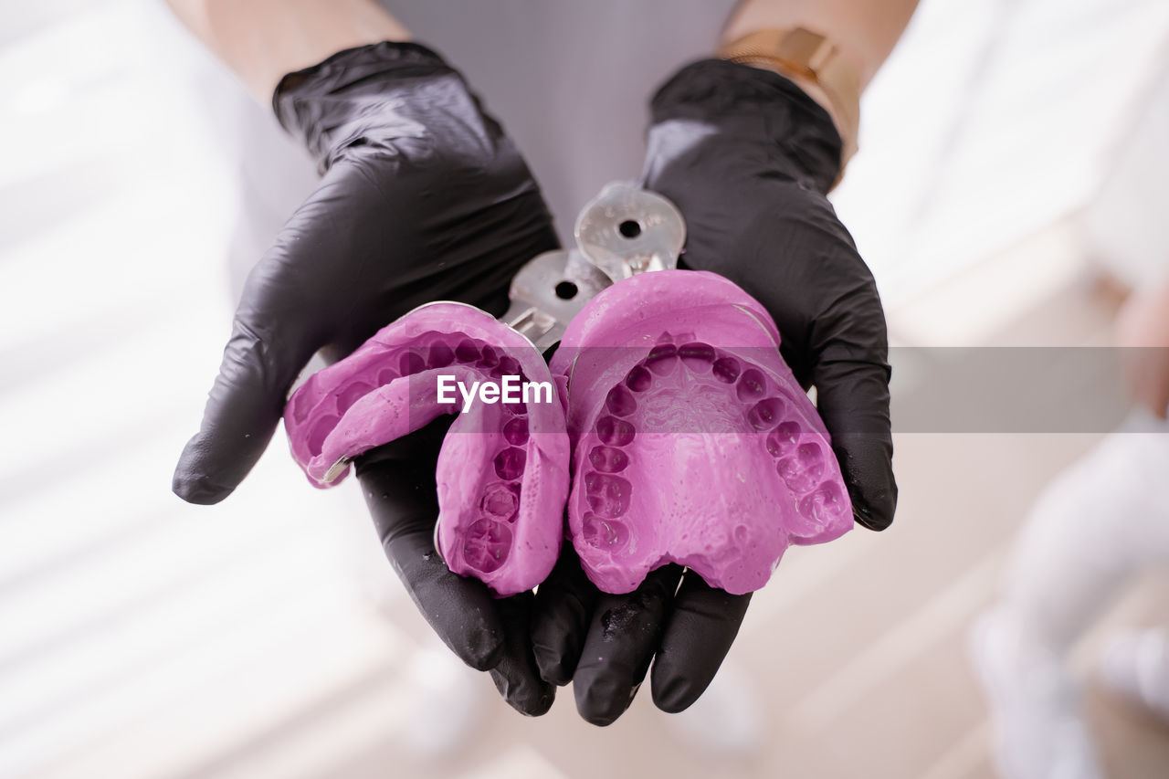 The orthodontist holds purple casts of the jaw in his hands, the process of orthodontic treatment