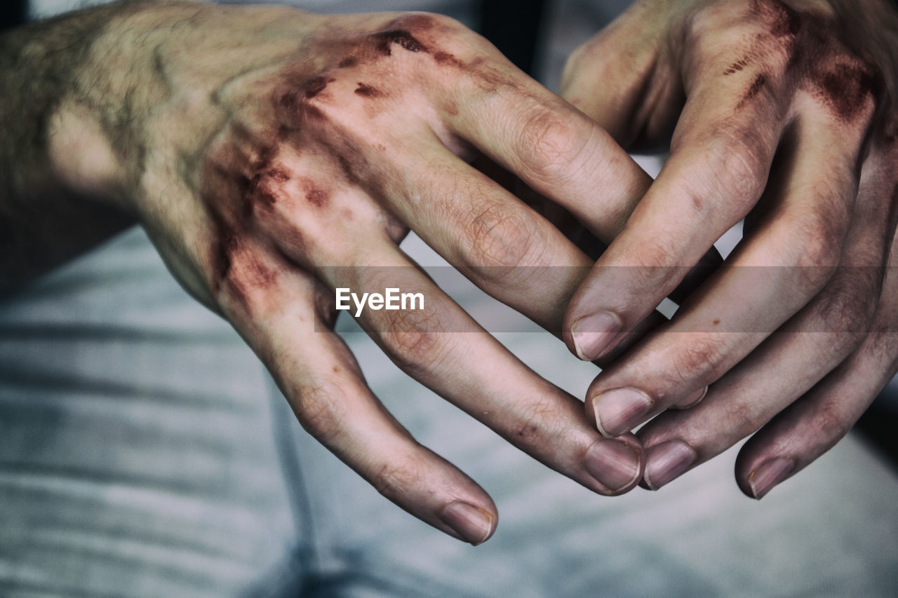 Cropped image of bruised hands of man