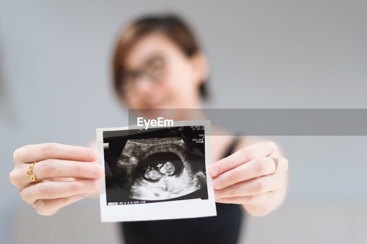 Woman holding instant print transfer of abdomen