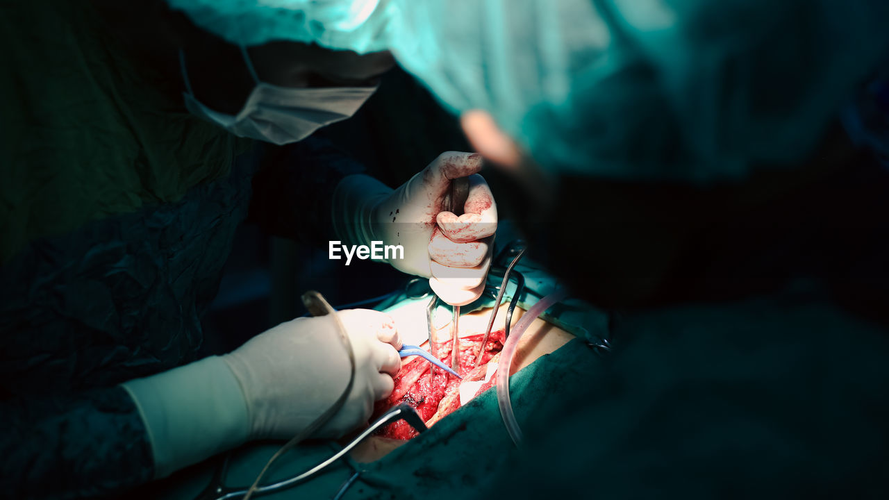 Doctors performing an appendectomy surgery, surgical concept