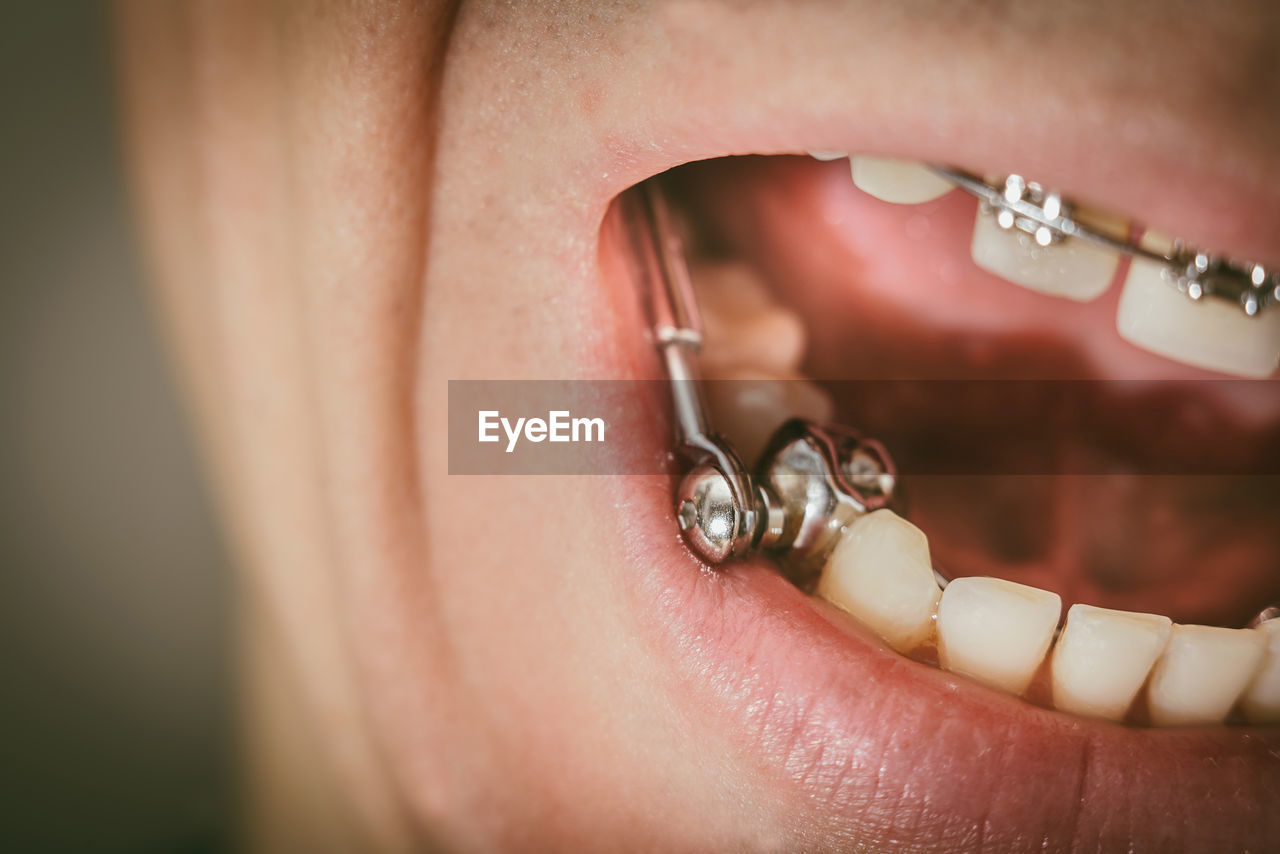 Close-up of man mouth wearing braces