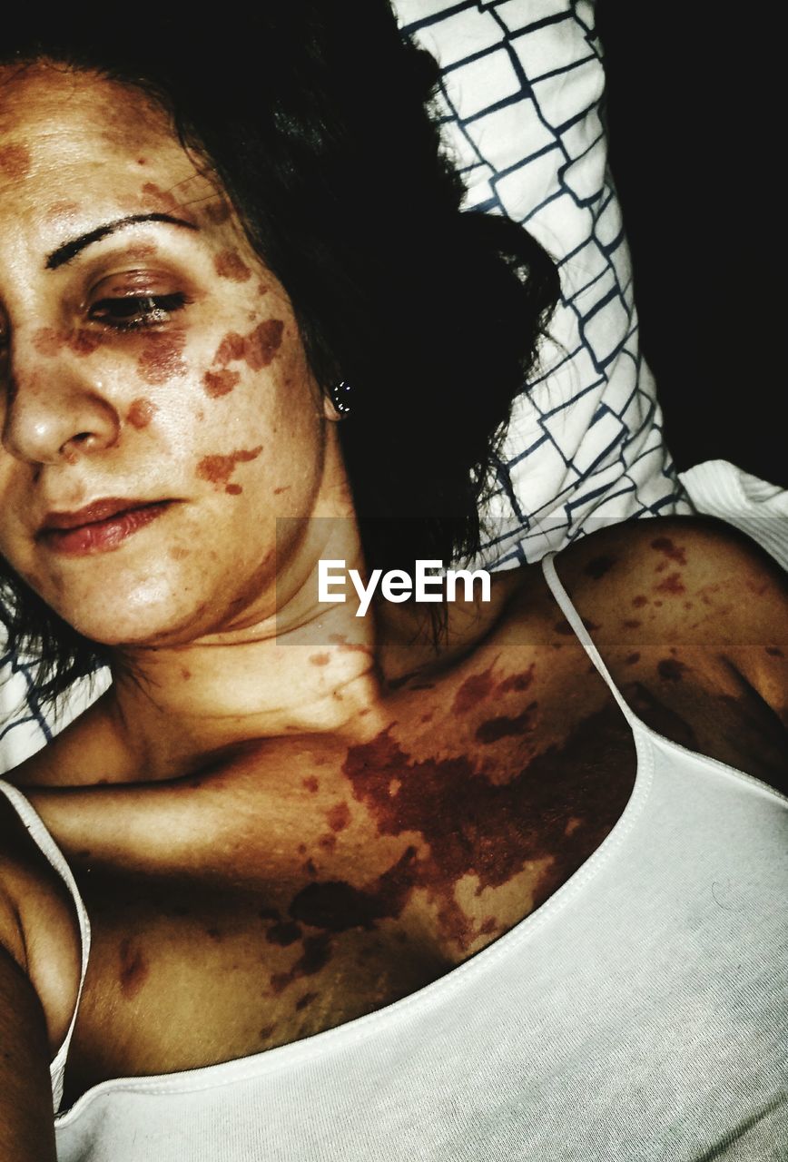 High angle view of woman with skin disease lying on bed at home