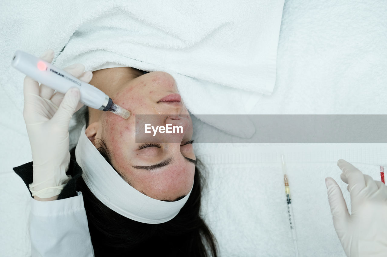 Top view of female patient having microneedling procedure applied on her face
