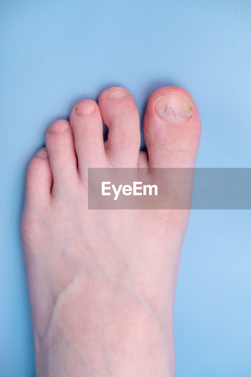 toe, finger, human leg, human foot, nose, one person, close-up, blue, limb, hand, arm, adult, indoors, blue background, barefoot, studio shot, nail, colored background, physical injury, human mouth, human limb, healthcare and medicine, relaxation, toenail