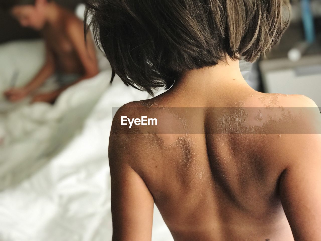 Rear view of shirtless girl with skin infection