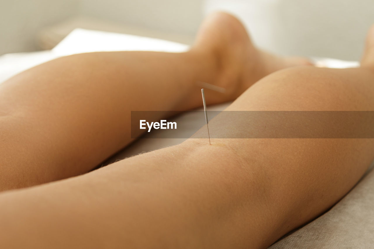 Low section of woman undergoing acupuncture treatment