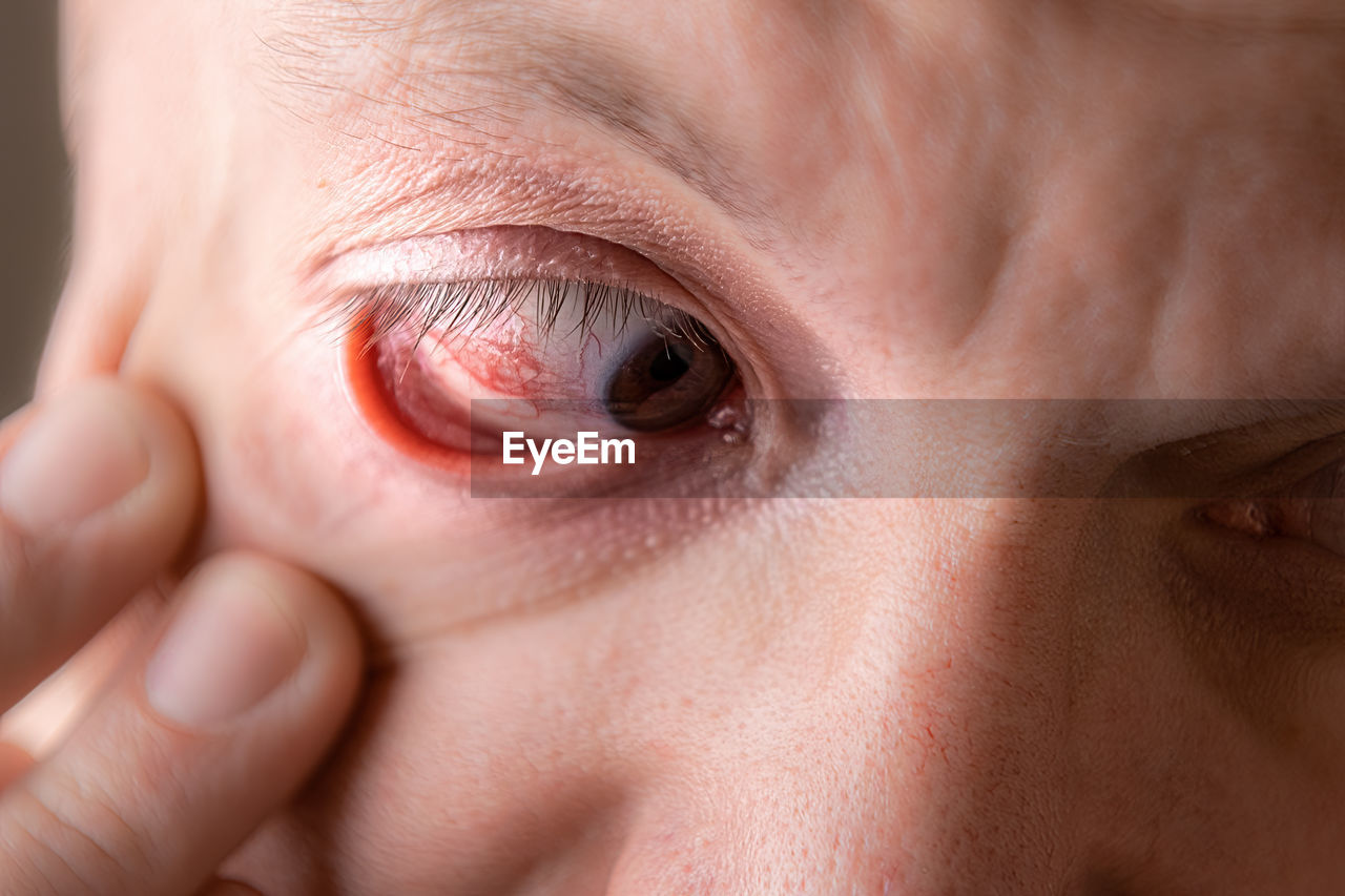 Subconjunctival hemorrhage - hyposphagma. close up of man's face showing red bloodshot eye.