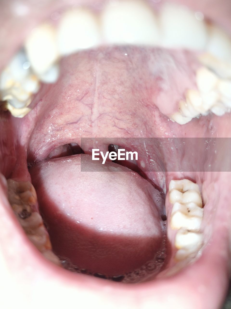 Close-up of food, mouth ulser, mouth open