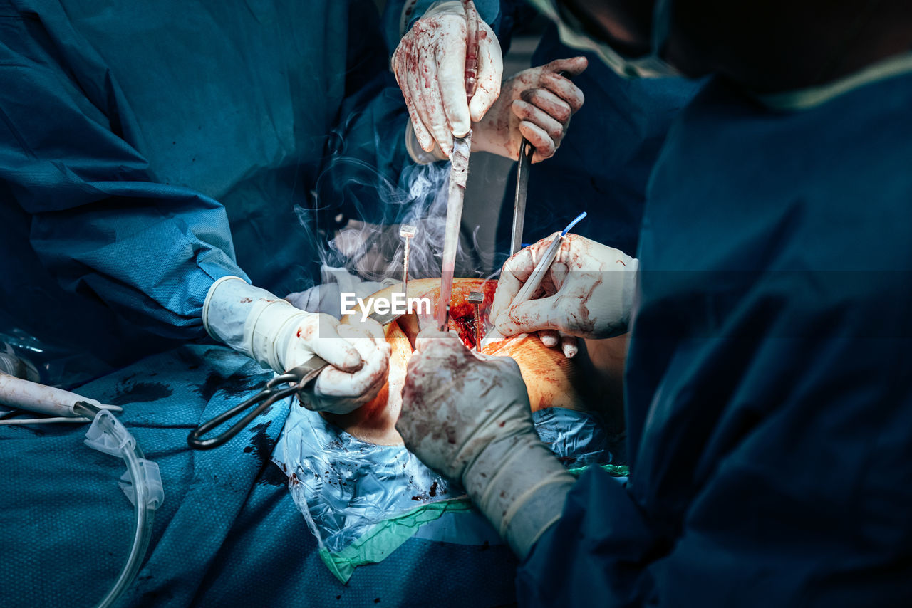 High angle view of doctors performing surgery