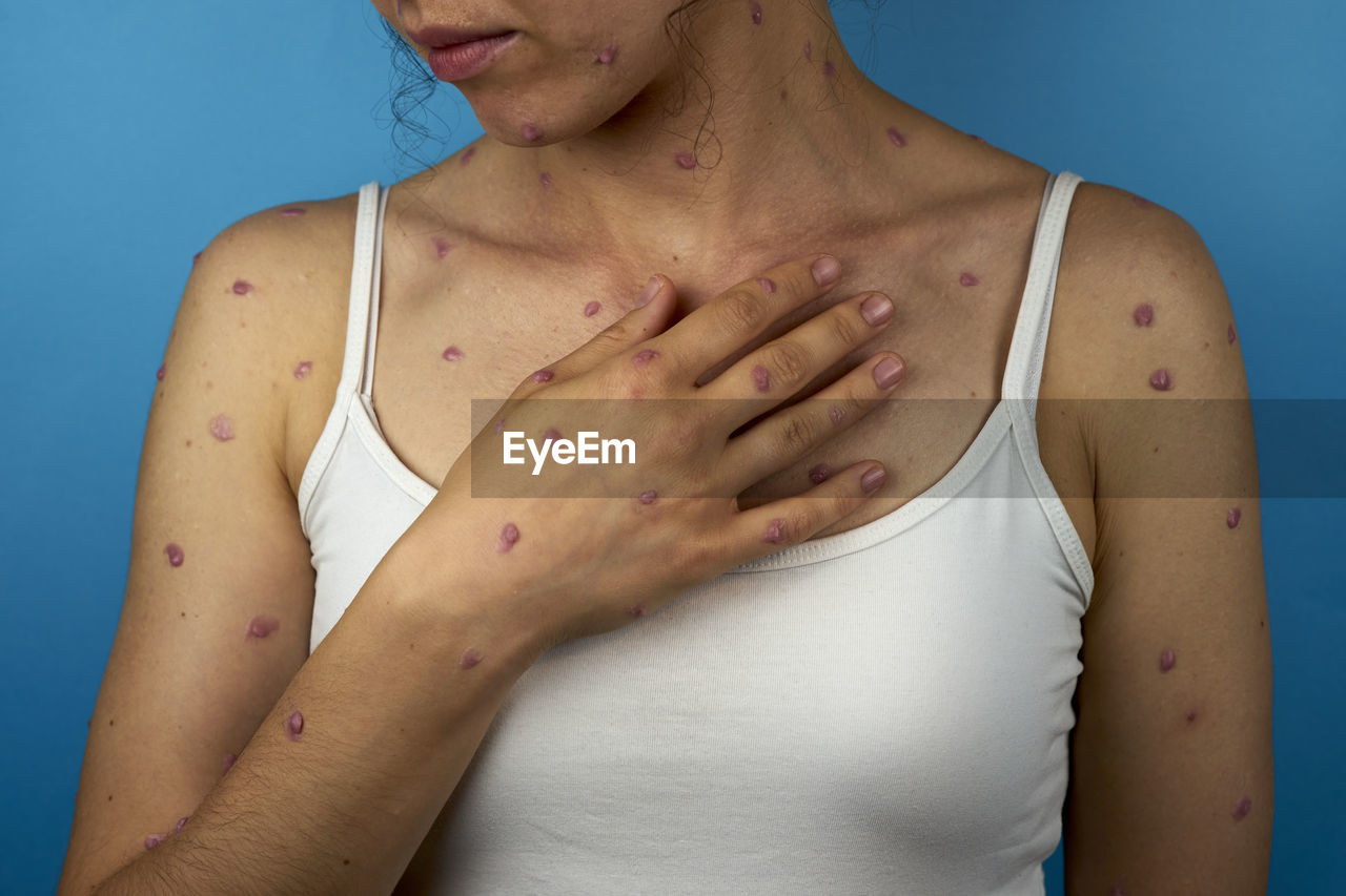 Infected woman with rash holding her hand on neckline