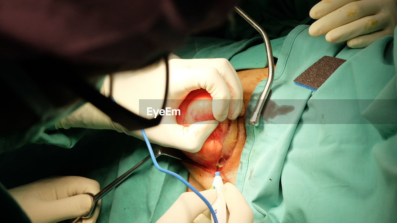 Midsection of surgeons performing operation on patient