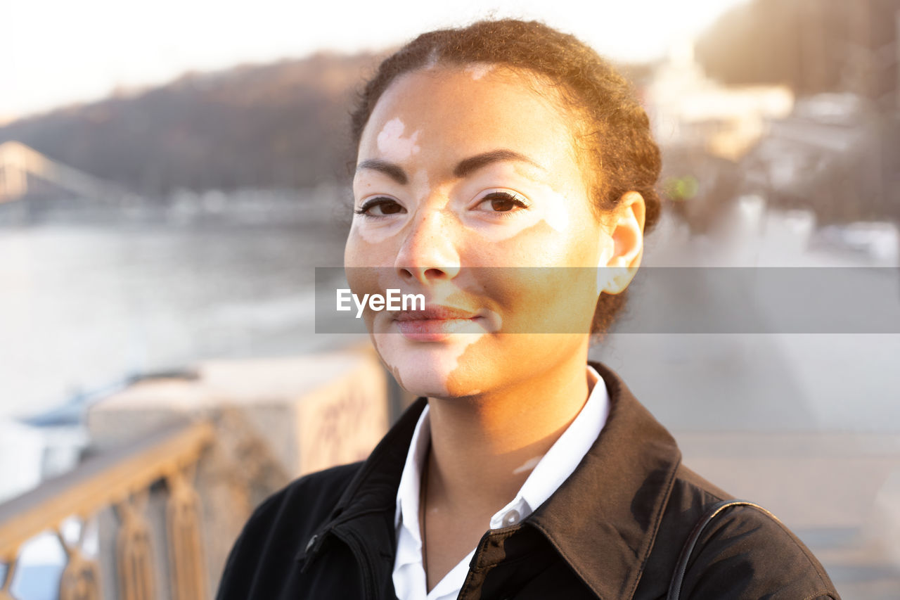 Portrait of young woman with vitiligo standing on footbridge over river