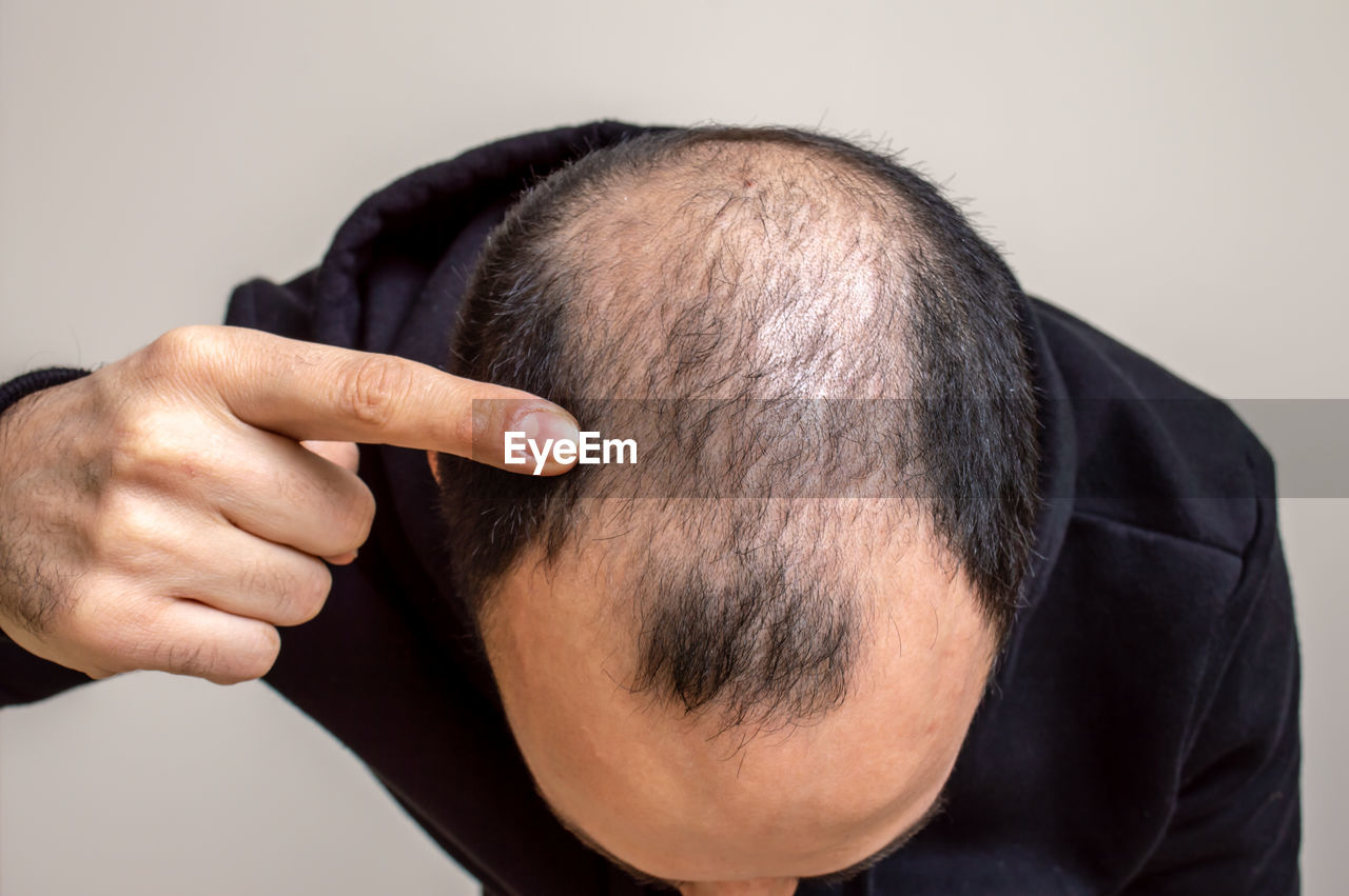 Close-up of man pointing at receding hairline against beige background