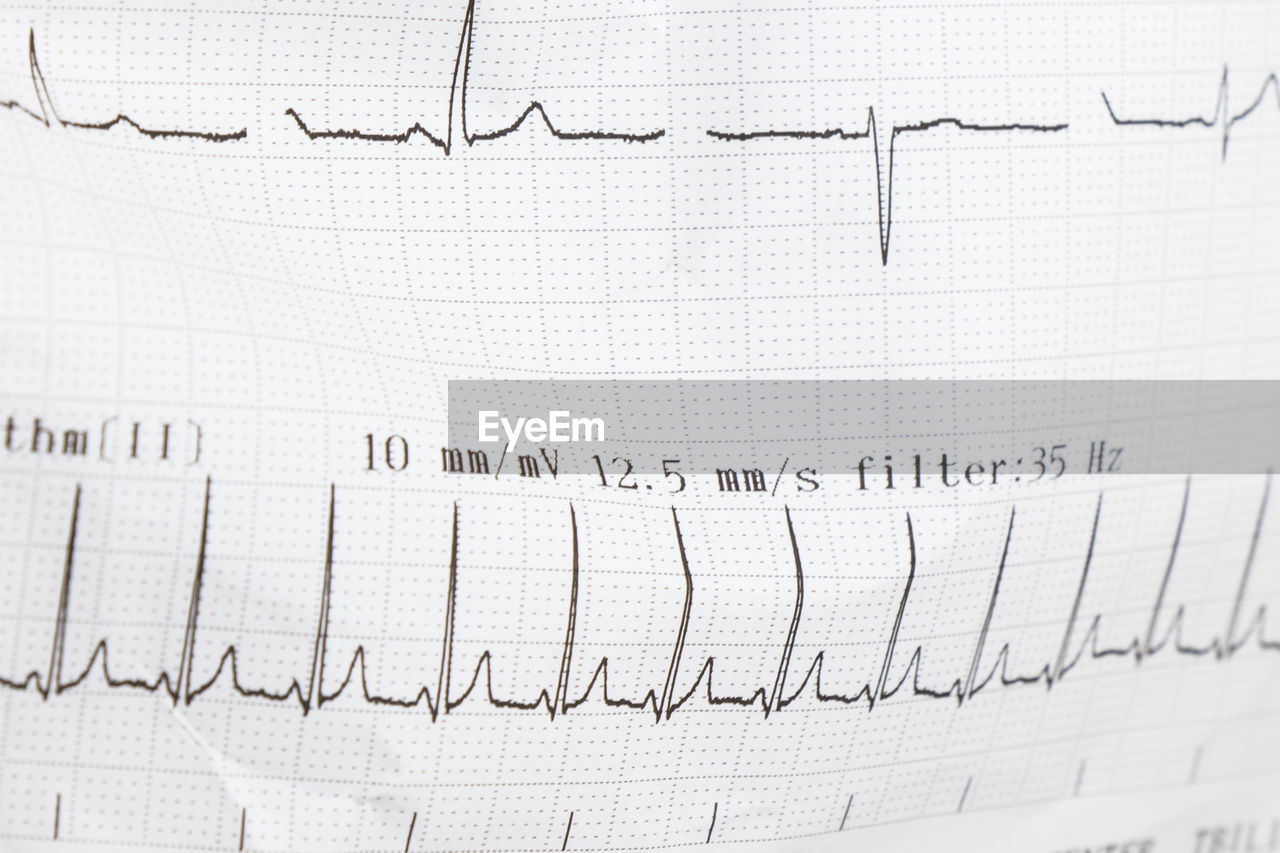 Cardiogram, waves of heart beat, ekg on the paper, arrhythmia