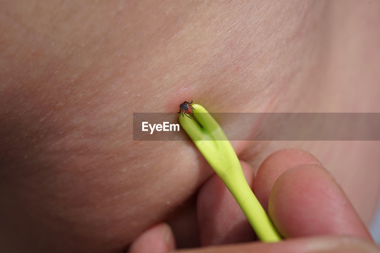 Removal of sucking tick, ixodes ricinus, from human skin with yellow tweezers