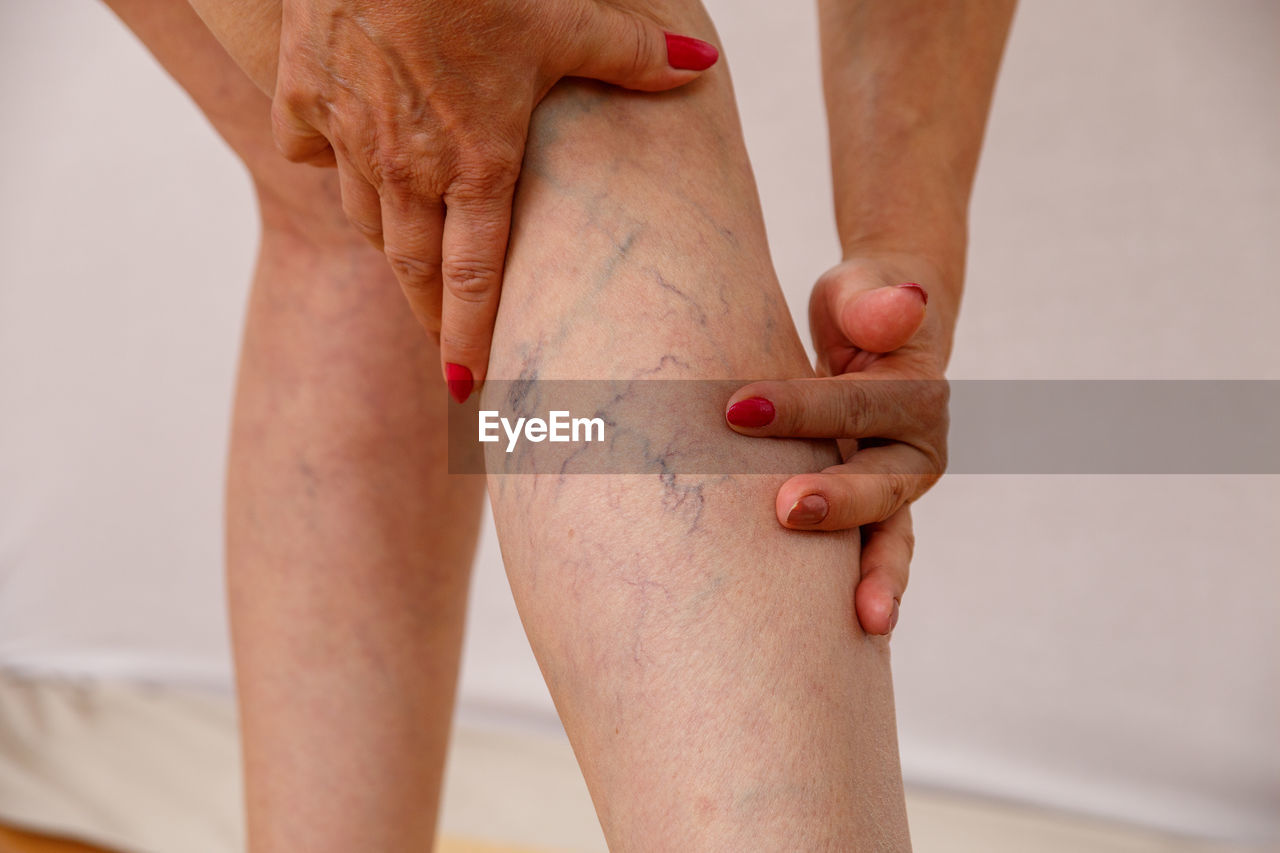 Midsection of woman touching veins of leg