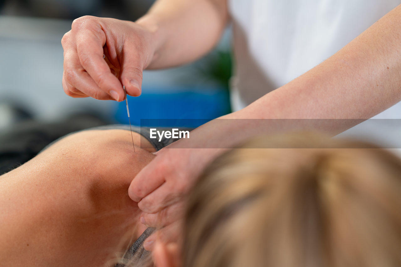 Unrecognizable physiotherapist inserting needle into shoulder of relaxed female patient during acupuncture session in clinic