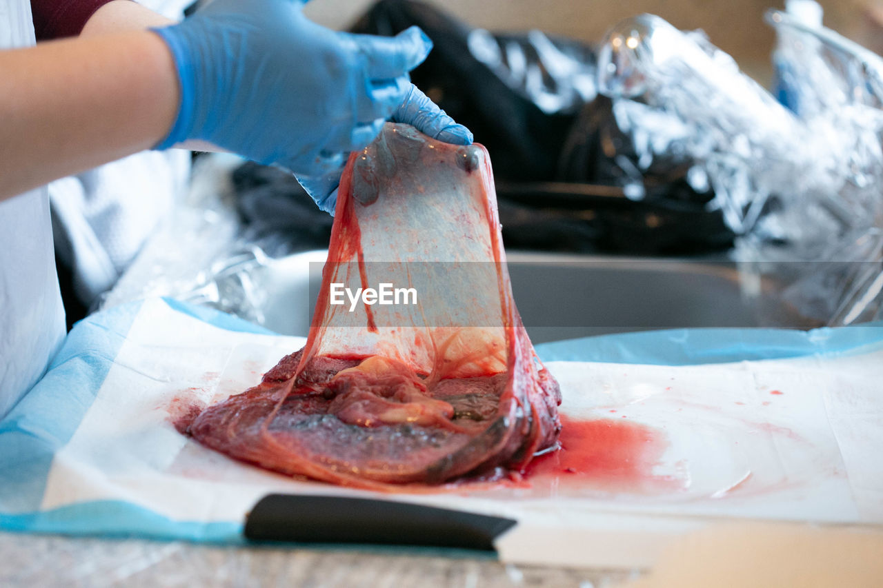 Gloved hands holding open amniotic sac attached to placenta.