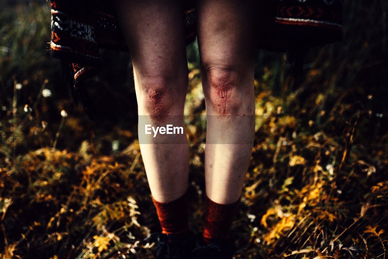 Bruised legs of woman standing on field