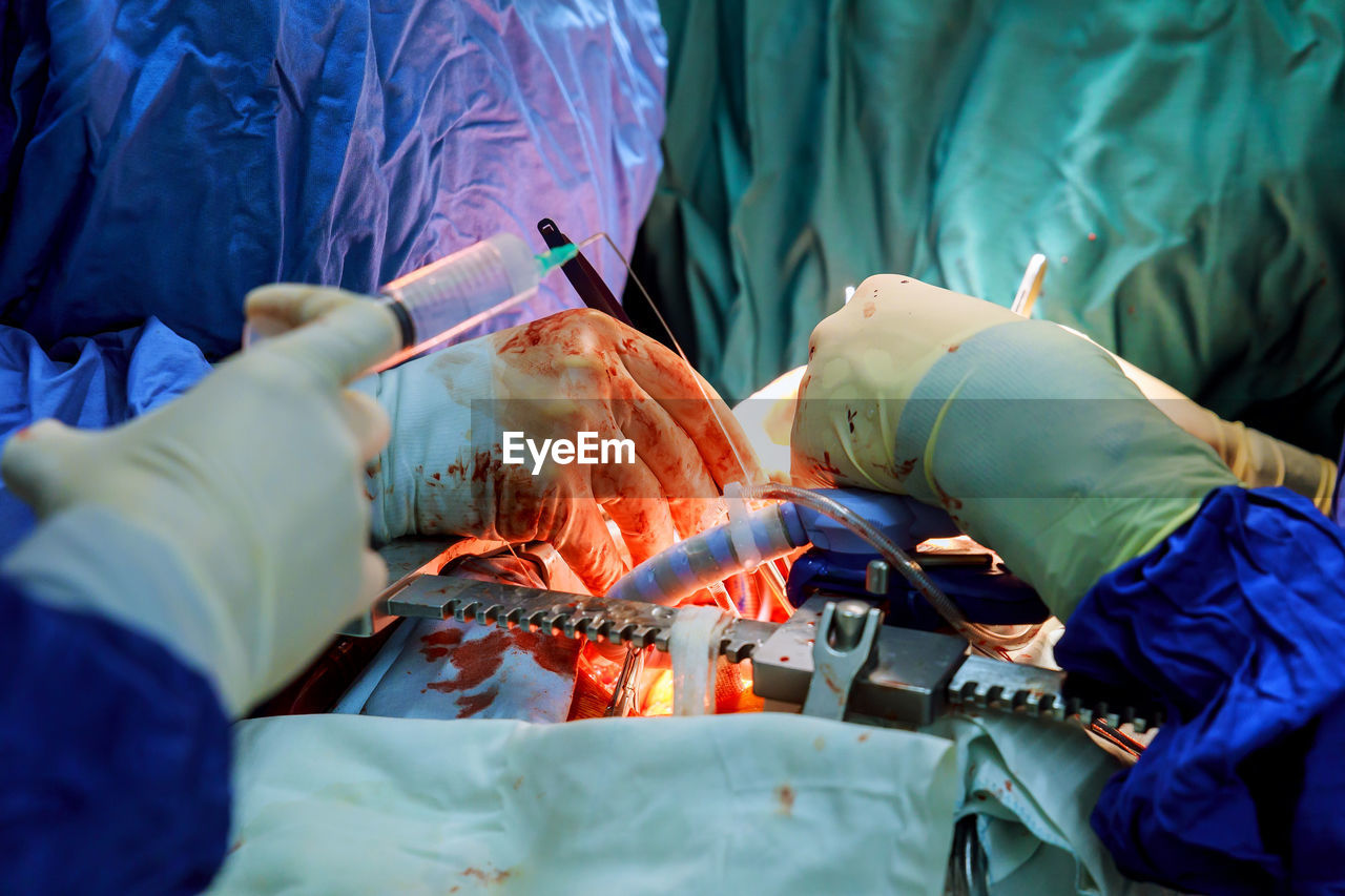 Cropped image of surgeons performing surgery
