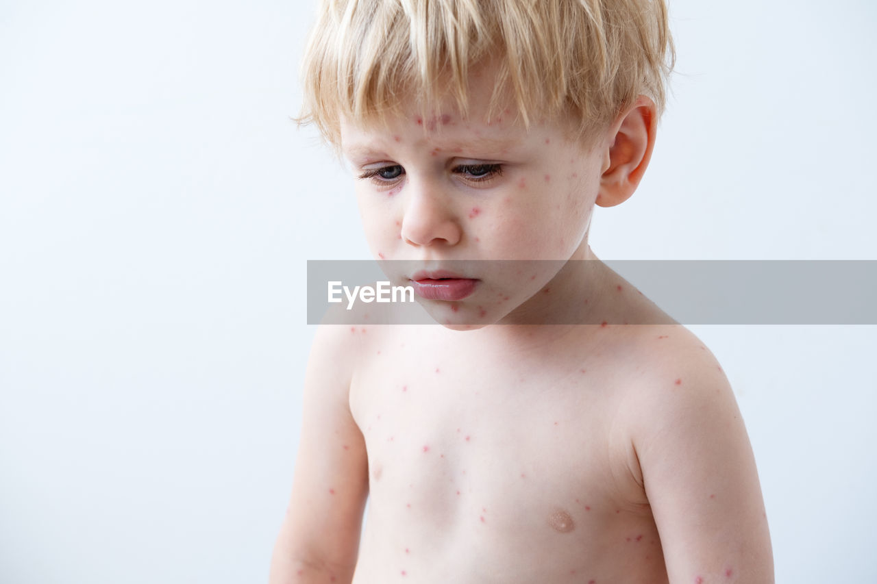 Chickenpox disease, portrait of blonde little boy with red rashes chicken pox virus