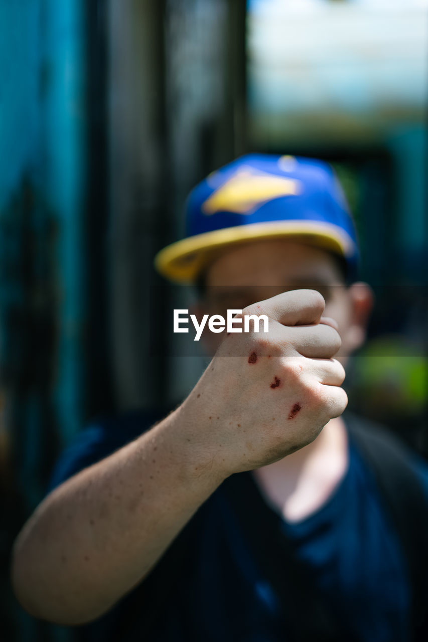 Young man showing injured hand