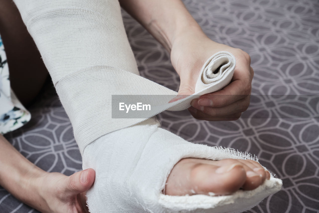 Applying an elastic bandage to a broken leg. the leg is in a plaster cast. 