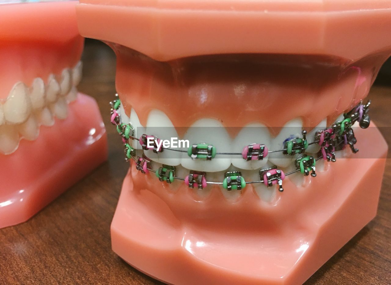 Close-up of teeth and braces