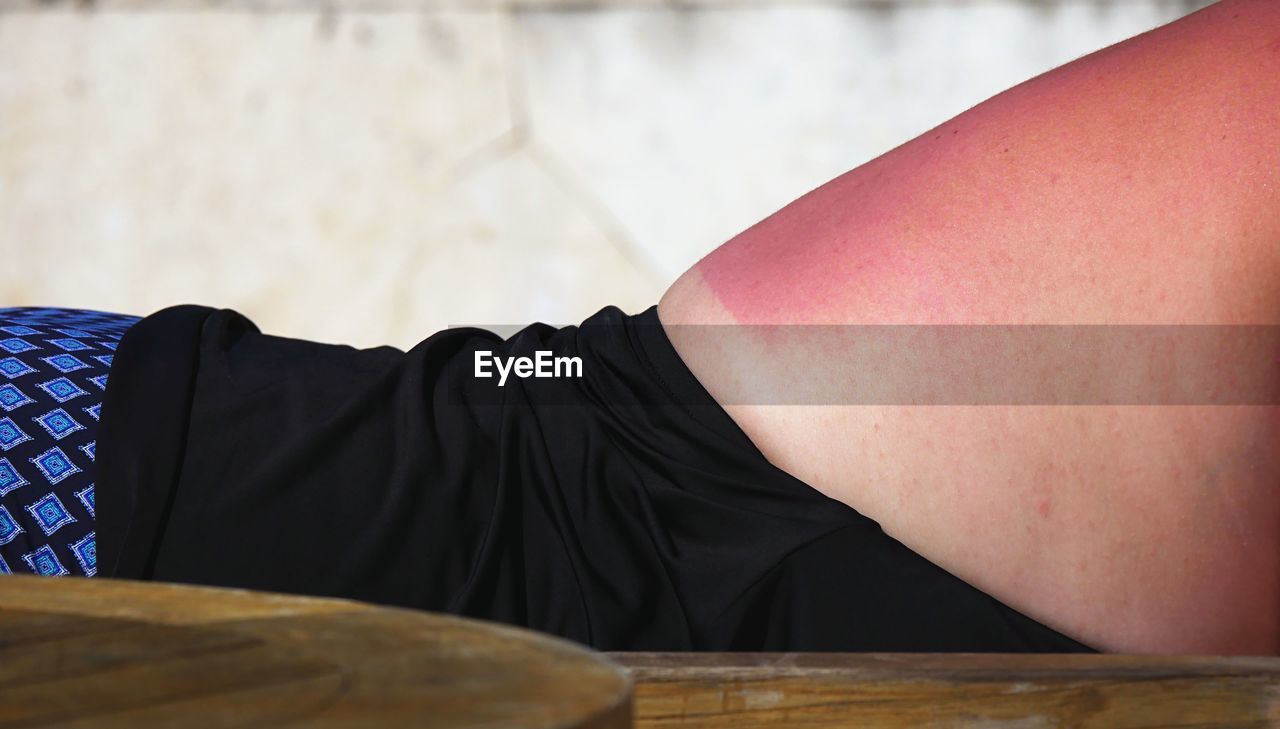 Midsection of woman with sunburn lying down