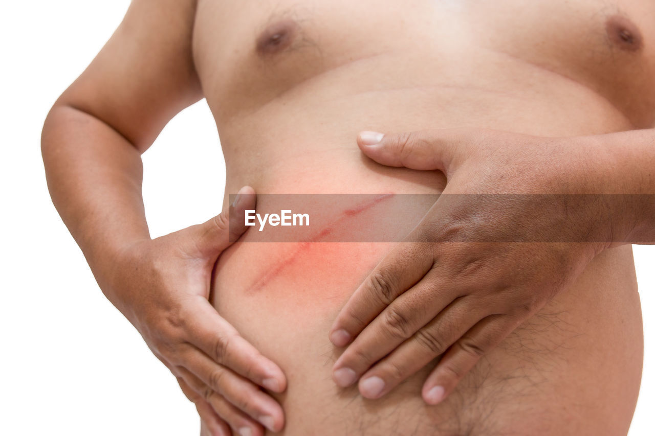 Midsection of shirtless man with bruise on abdomen against white background