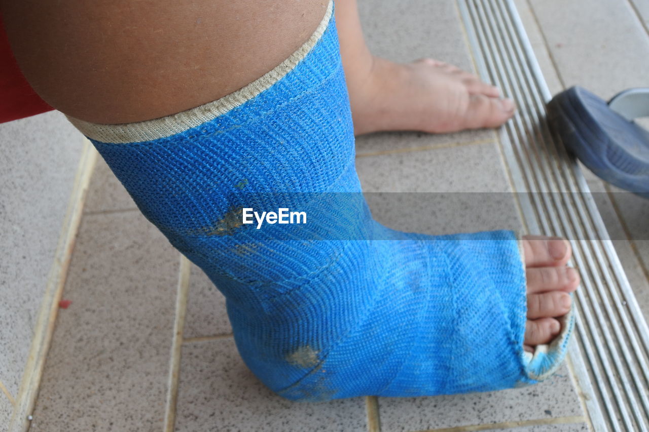 Low section of woman with fractured leg