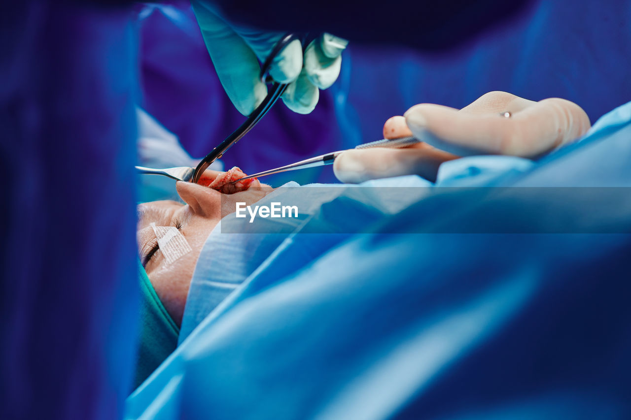 Crop unrecognizable surgeon in protective gloves suturing wound on nose of anonymous patient during rhinoplasty surgery in hospital