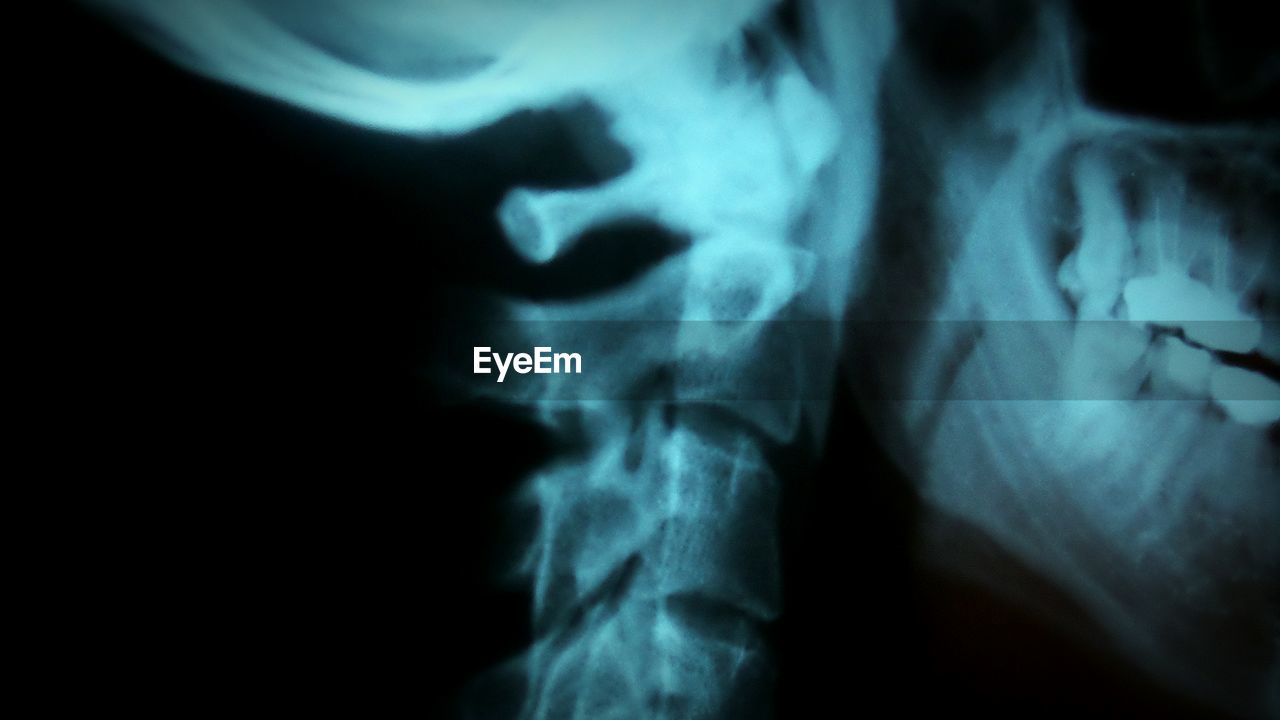 Close-up of neck and spine x-ray