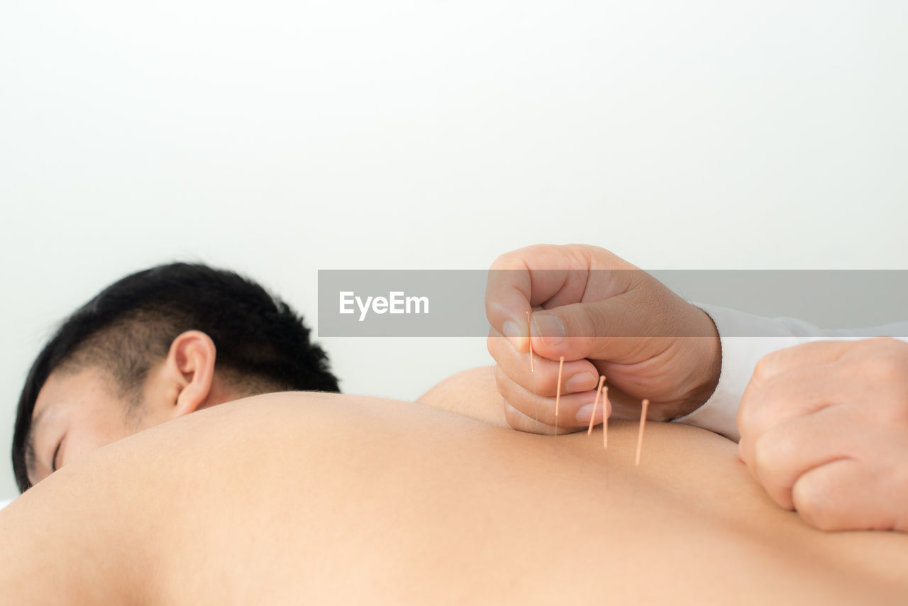 Shirtless man getting acupuncture treatment at hospital