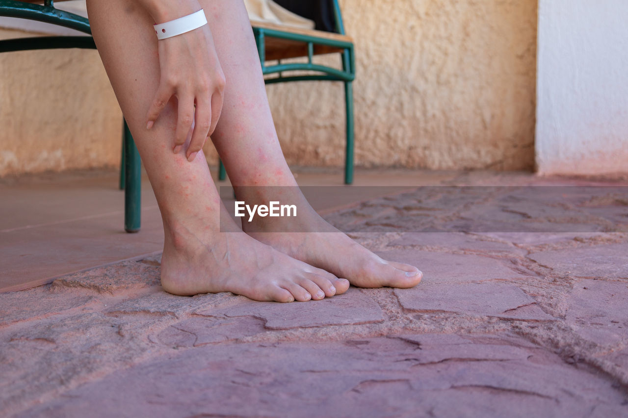 Girl's legs bitten by mosquitoes, close-up. woman scratching her feet bitten by insects.