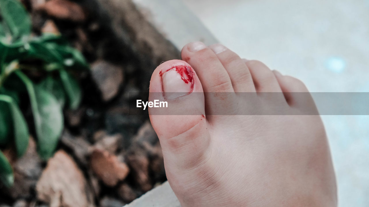 A wound on the toenail