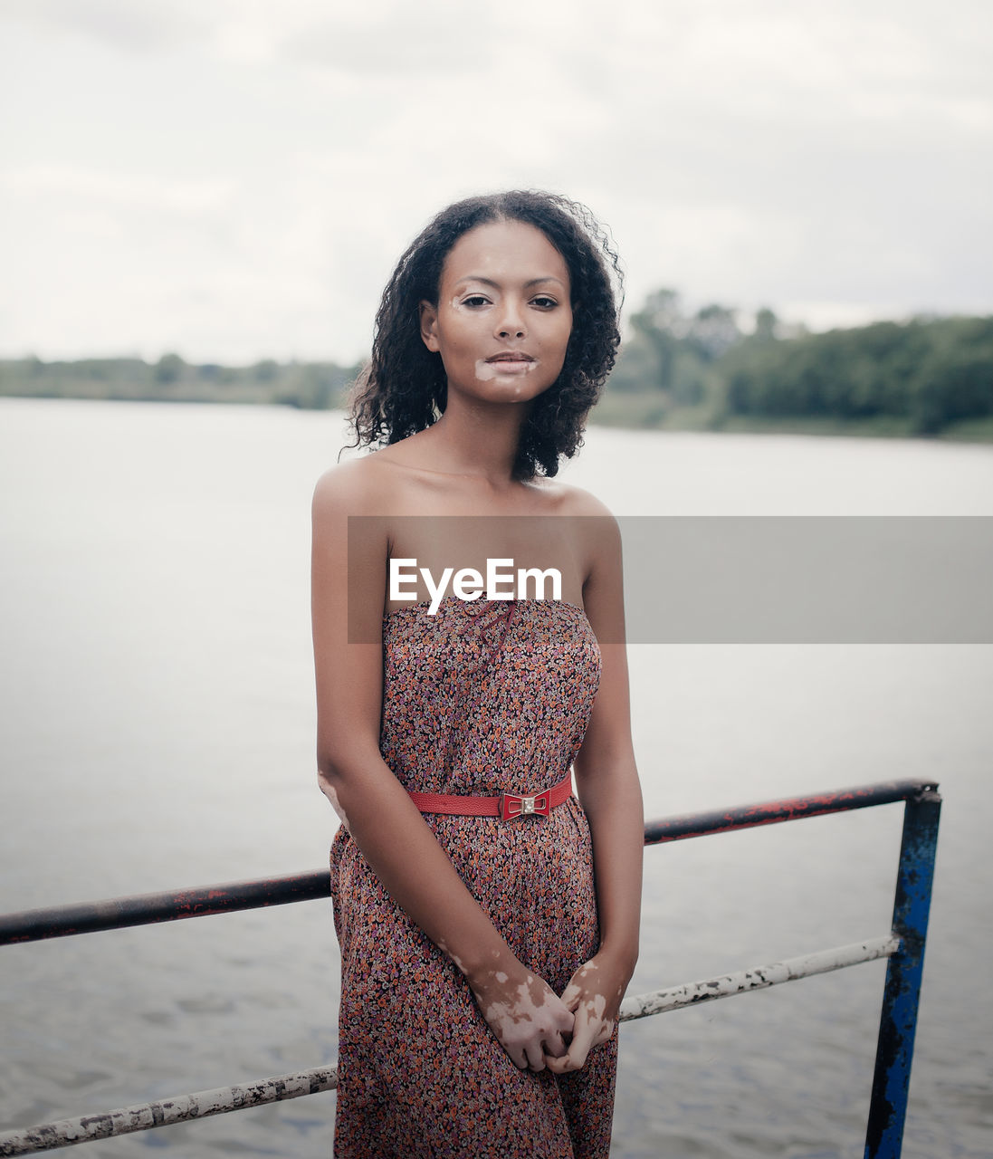 Portrait of woman suffering from vitiligo standing against lake