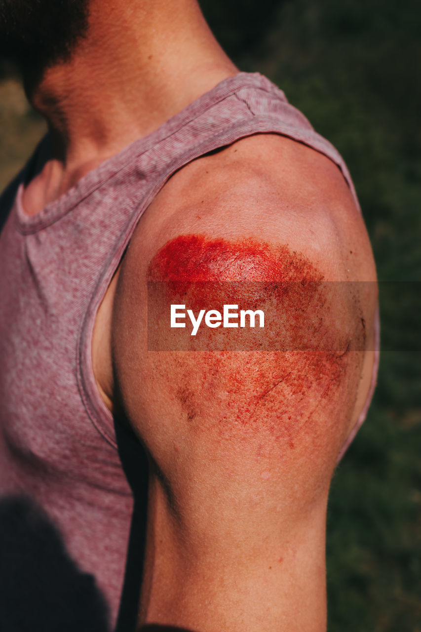 Abrasion on human shoulder after skateboard accident