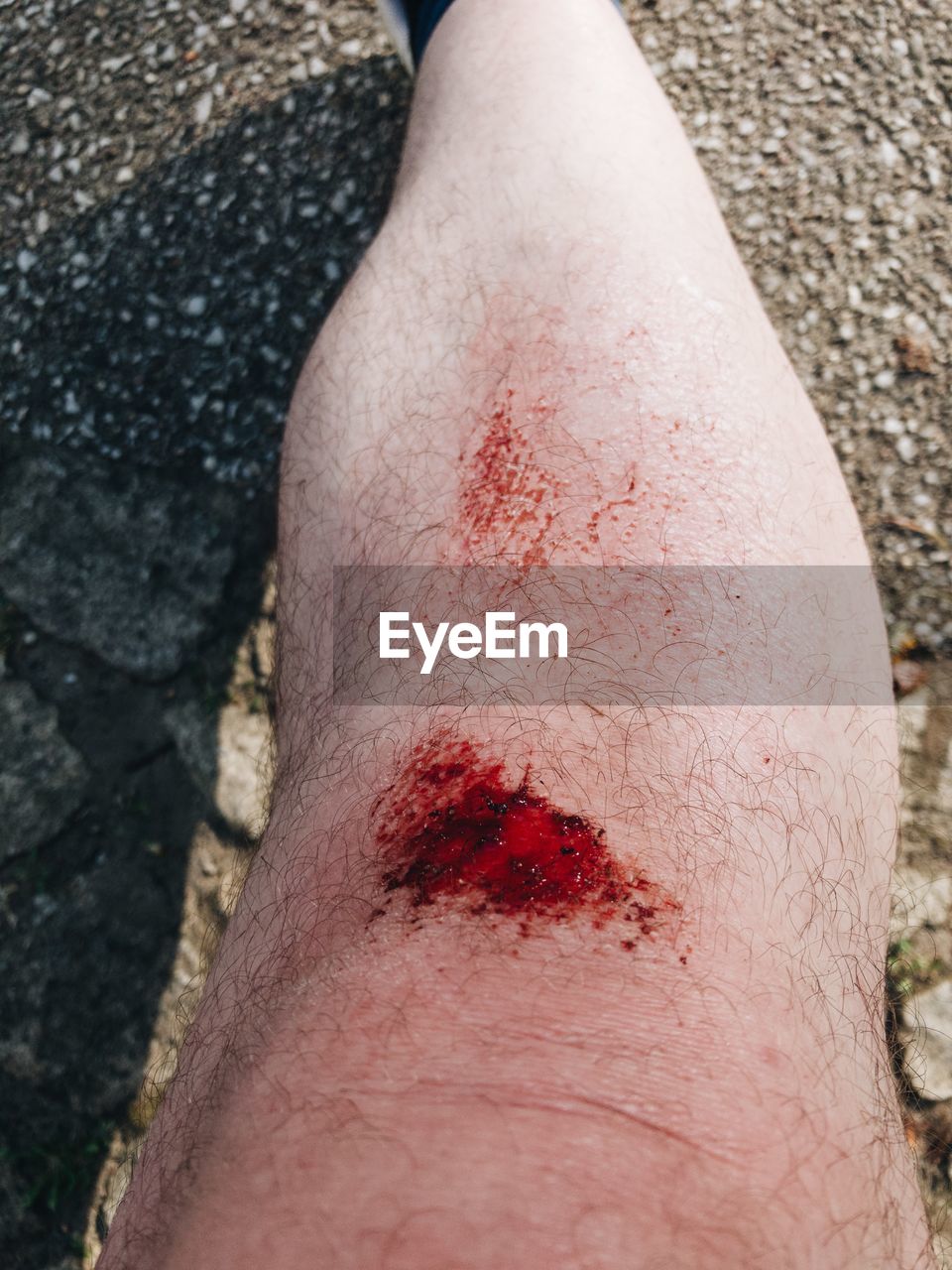 Close-up injured knee