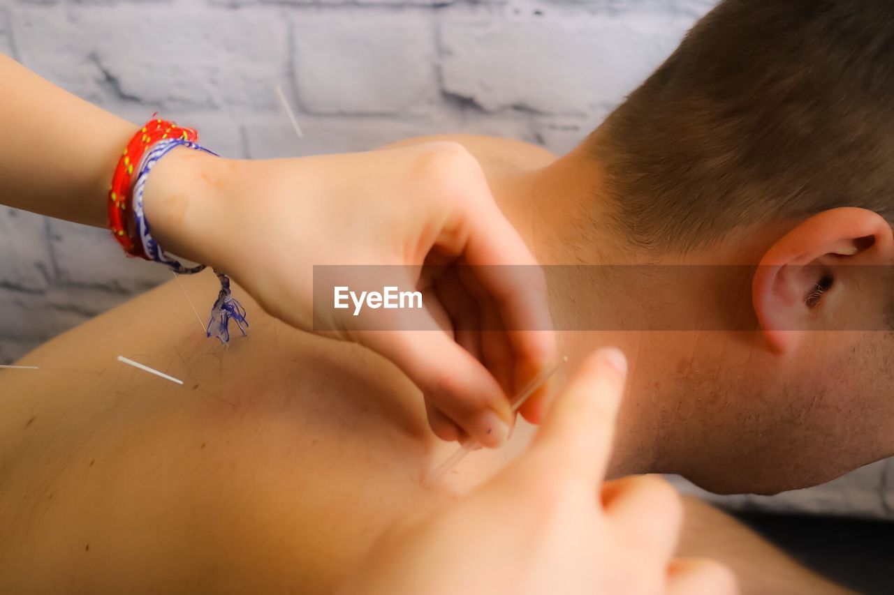 Cropped hand of female acupuncturist applying needle on man back