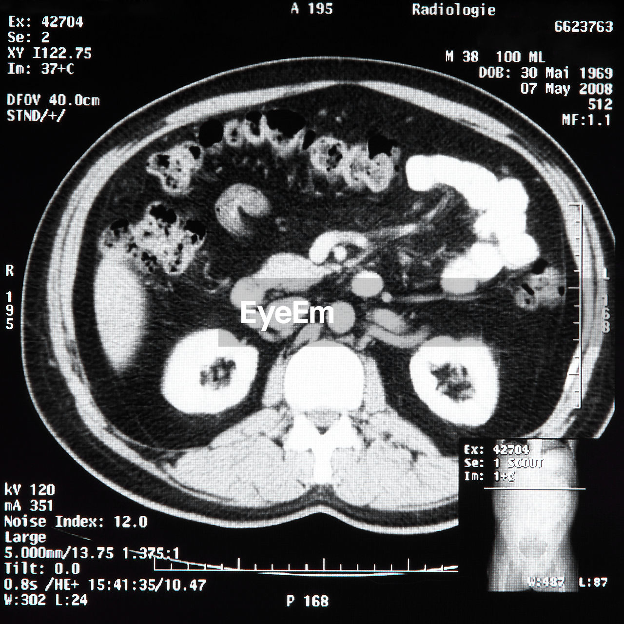 Ct scan of human abdomen