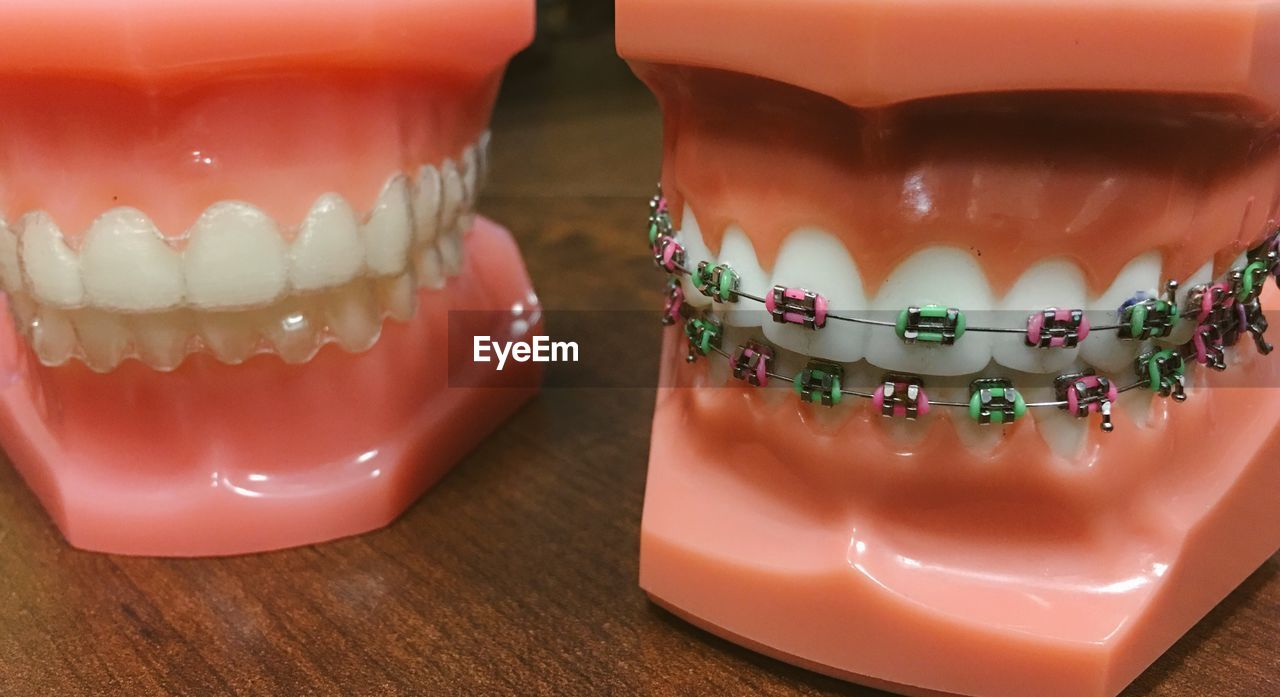 Close-up of teeth and braces