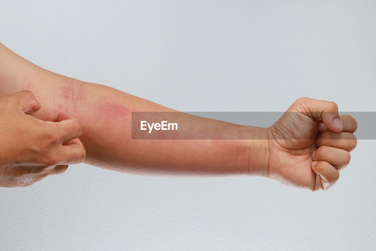 Cropped image of person scratching hand against white background