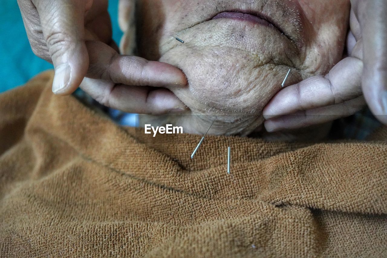 Close-up of cropped hands holding senior man with acupressure needles