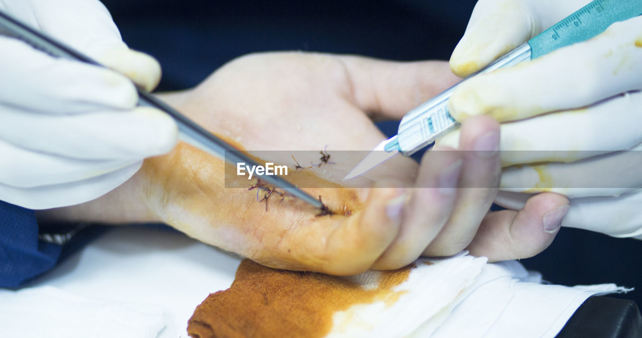 Cropped hands of doctor stitching hand