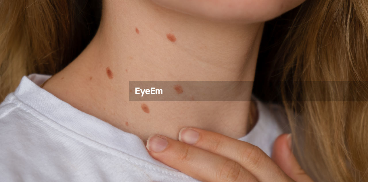 Unrecognizable woman showing her birthmarks on neck skin close up detail of the bare skin sun