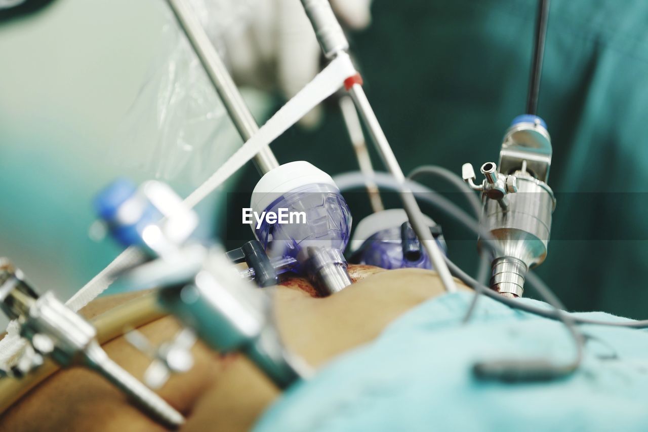 Midsection of patient with surgical equipment at hospital